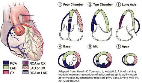 rwma echocardiogram